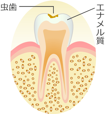 Ｃ１ ： エナメル質の虫歯
