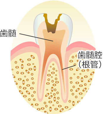 Ｃ３ ： 歯髄（歯の神経）の虫歯