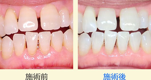 ホワイトニングの効果を前歯で比較