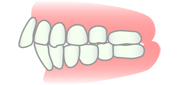 上顎前突