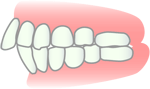上顎前突（出っ歯）の床矯正による治療例