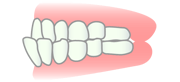 下顎前突・反対咬合・受け口