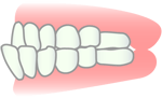 反対咬合はできるだけ早い床矯正（３歳くらいから可能）がお勧めです。