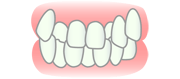 叢生（そうせい）・八重歯・乱ぐい歯