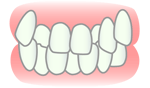 叢生（そうせい）は７～９歳くらいからの床矯正がお勧めです。
