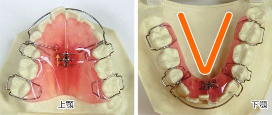 床矯正をした方が良い不正咬合（Ｖ字型の狭窄歯列弓）