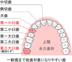 一般矯正で抜歯対象になりやすい歯