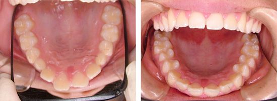 床矯正で上顎前突（出っ歯）を治したＭ・Ｓ君 の治療例