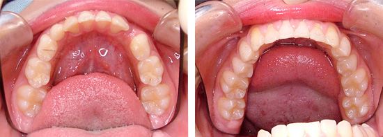 床矯正で上顎前突（出っ歯）を治したＭ・Ｓ君 の治療例