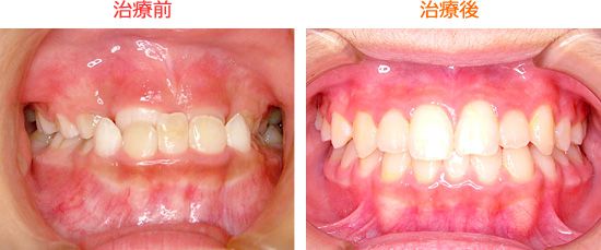 床矯正で下顎前突（反対咬合・受け口）を治したＴ・Ｔ君 の治療例