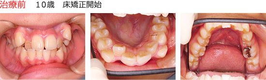 治療前　１０歳　床矯正開始