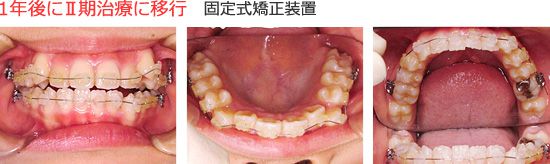 １年後にⅡ期治療に移行　固定式矯正装置を装着