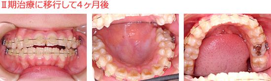 １年後にⅡ期治療に移行　固定式矯正装置を装着