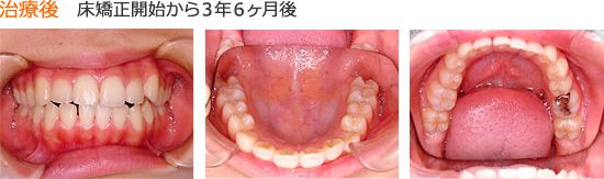 治療後　床矯正開始から３年６ヶ月できれいな歯並びになりました