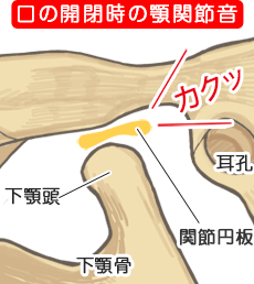 開口障害 - 痛くて口を開くことができない