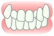 不揃いな歯並び、例えば叢生