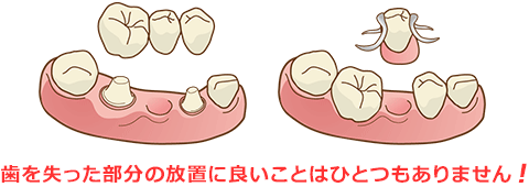 歯を失った部分の放置に良いことはひとつもありません