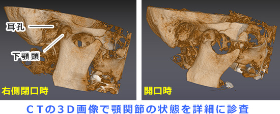 ＣＴの３Ｄ画像で顎関節の状態を詳細に診査