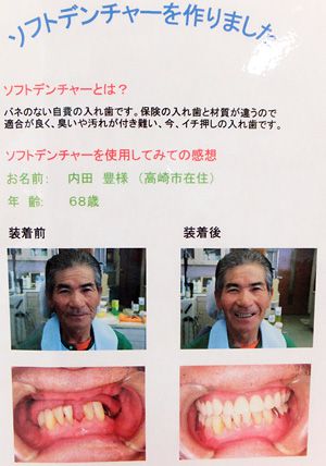 入れ歯の情報「ソフトデンチャー作りました」