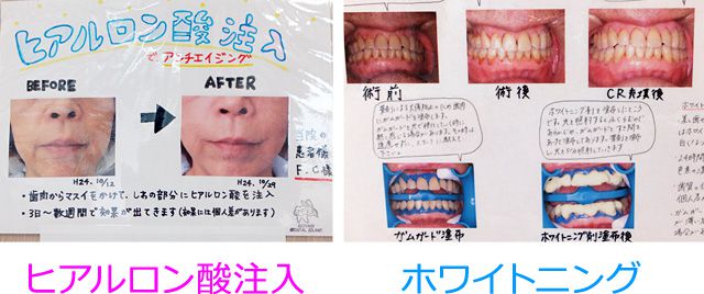 アンチエイジング「ヒアルロン酸注入」とホワイトニングの掲示物