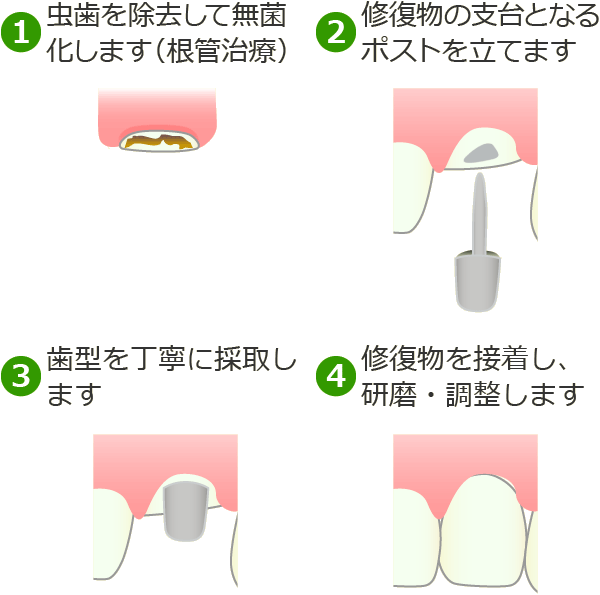 クラウン修復法