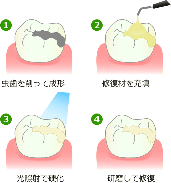 ダイレクトボンディング法