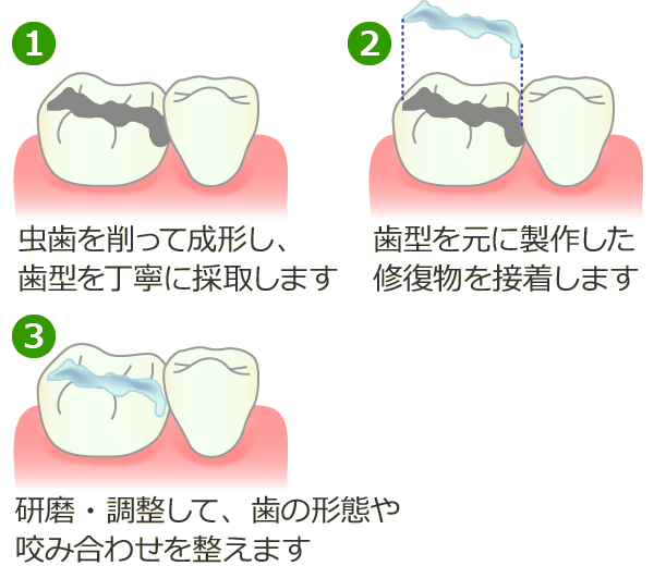 インレー修復法
