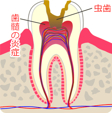 歯髄炎