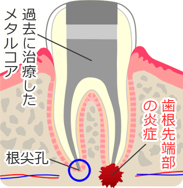 根尖性歯周炎