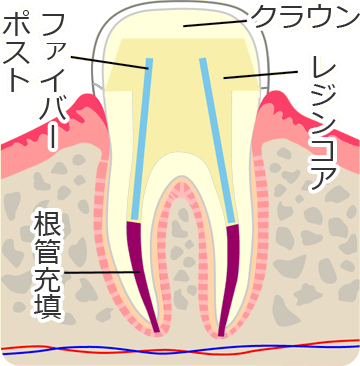 メタルフリーの根管治療「ファイバーポスト・レジンコア」