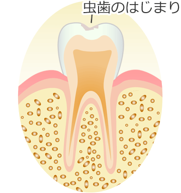 ＣＯ ： 初期虫歯