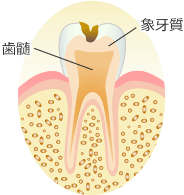 Ｃ２ ： 象牙質の虫歯