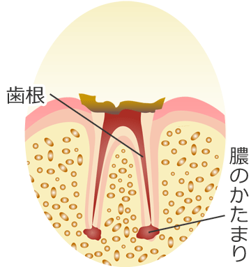 Ｃ４ ： 末期の虫歯