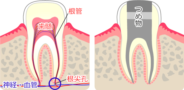 健康な歯と根管治療・抜髄処置後