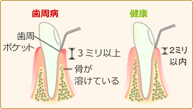 歯周ポケットの深度測定