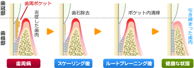 スケーリング・ルートプレーニング