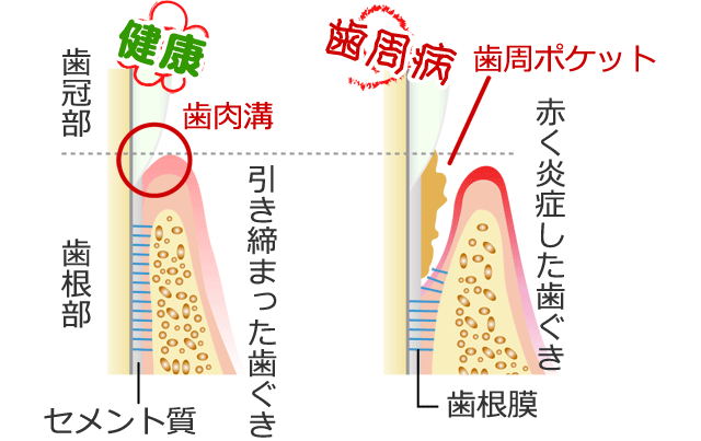 歯肉溝と歯周ポケット