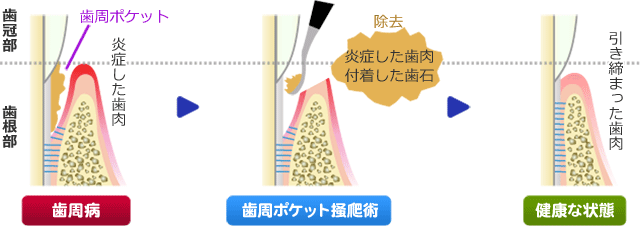 歯周ポケット掻爬（そうは）術