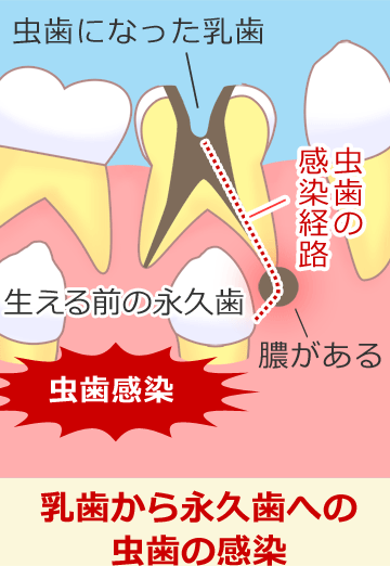 乳歯から永久歯への虫歯の感染経路