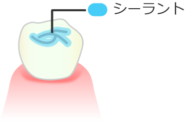 子供の奥歯の溝はシーラントで虫歯予防