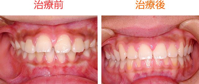 床矯正で上顎前突(出っ歯)を治したM・S君 の治療例