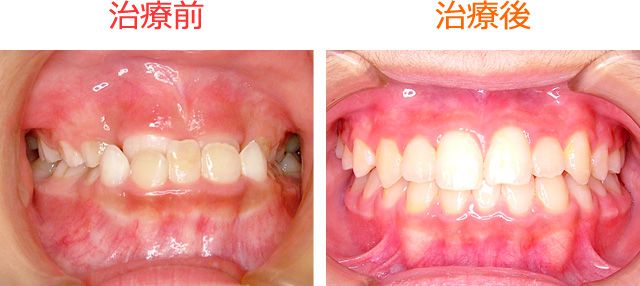 床矯正で下顎前突（反対咬合・受け口）を治したＴ・Ｔ君 の治療例