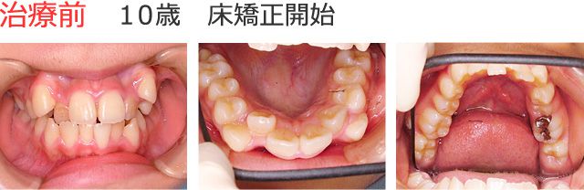 治療前 10歳 床矯正開始