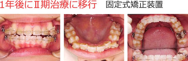 1年後にⅡ期治療に移行 固定式矯正装置を装着