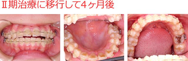 1年後にⅡ期治療に移行 固定式矯正装置を装着