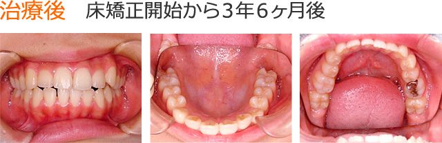 治療後 床矯正開始から3年6ヶ月できれいな歯並びになりました