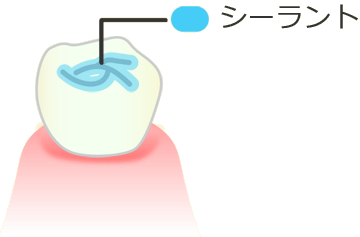 歯を守るバリア　シーラント