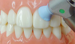 ホワイトニング施術前の歯面クリーニング