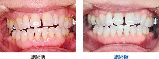 ホワイトニングの効果を前歯で比較